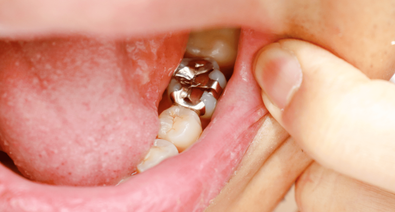 Amalgam Fillings