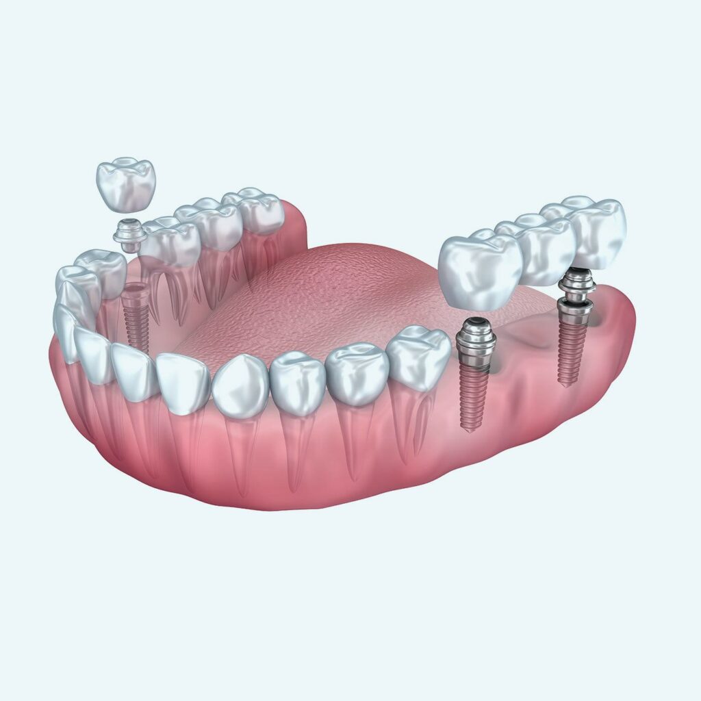 Multiple Teeth Replacement